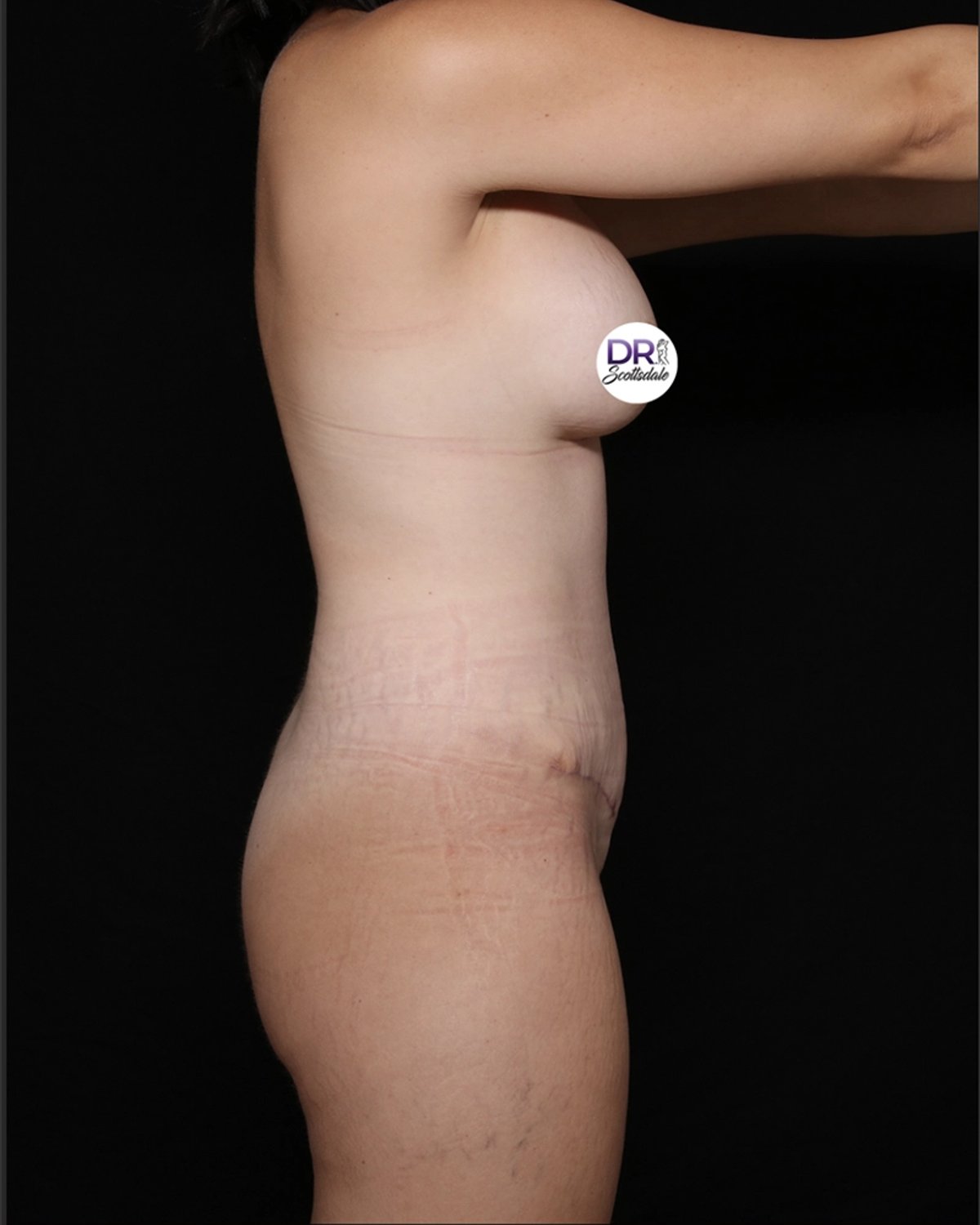 Breast Augmentation with Implants after