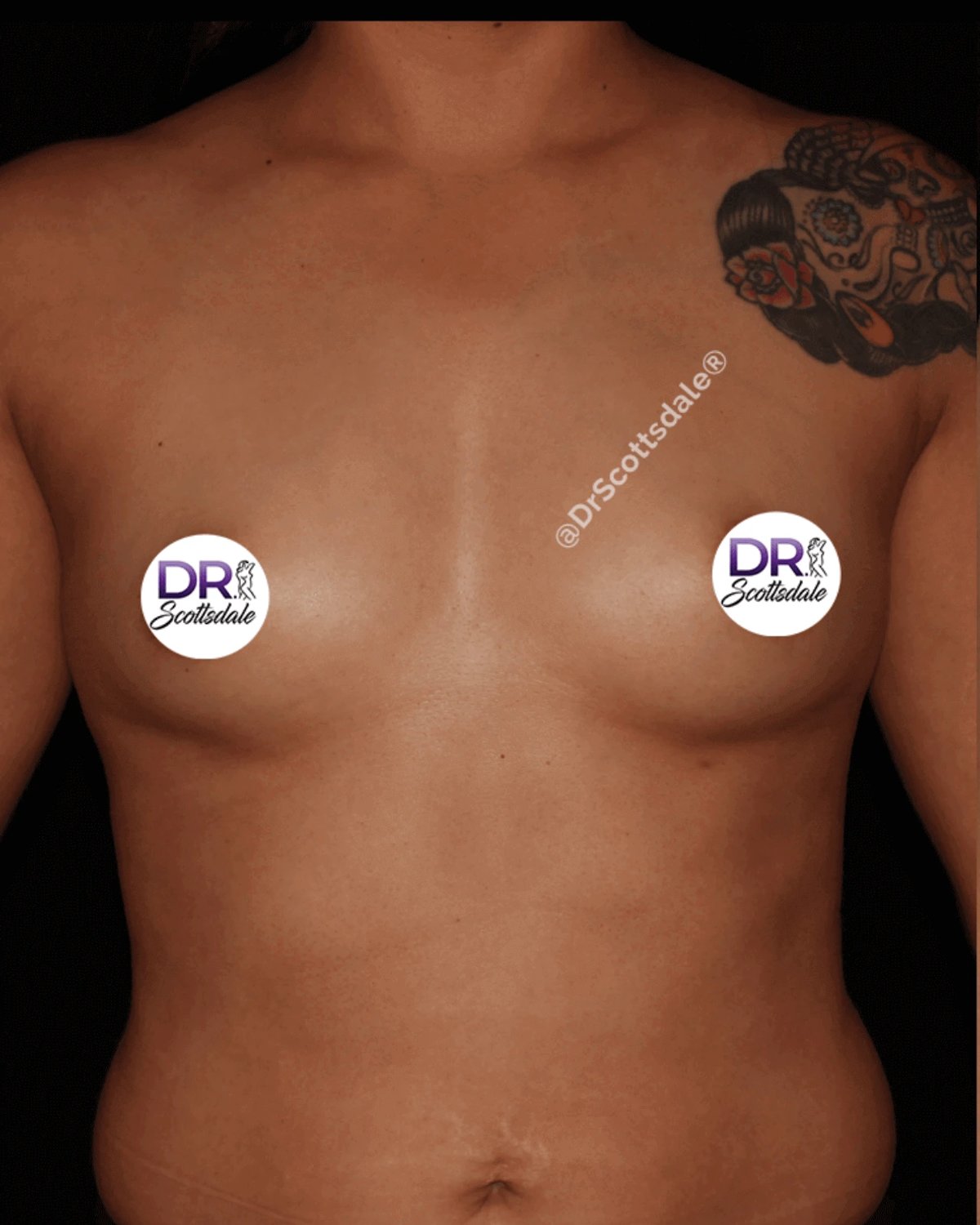 Breast Augmentation with Implants before