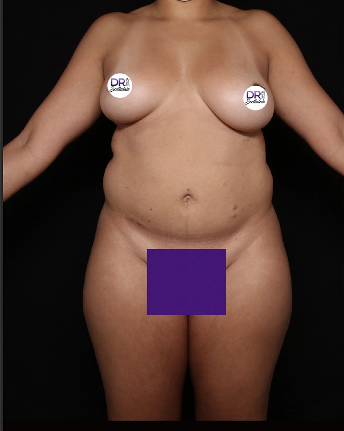 Front Liposuction (5L) (Same As Lipo360) before