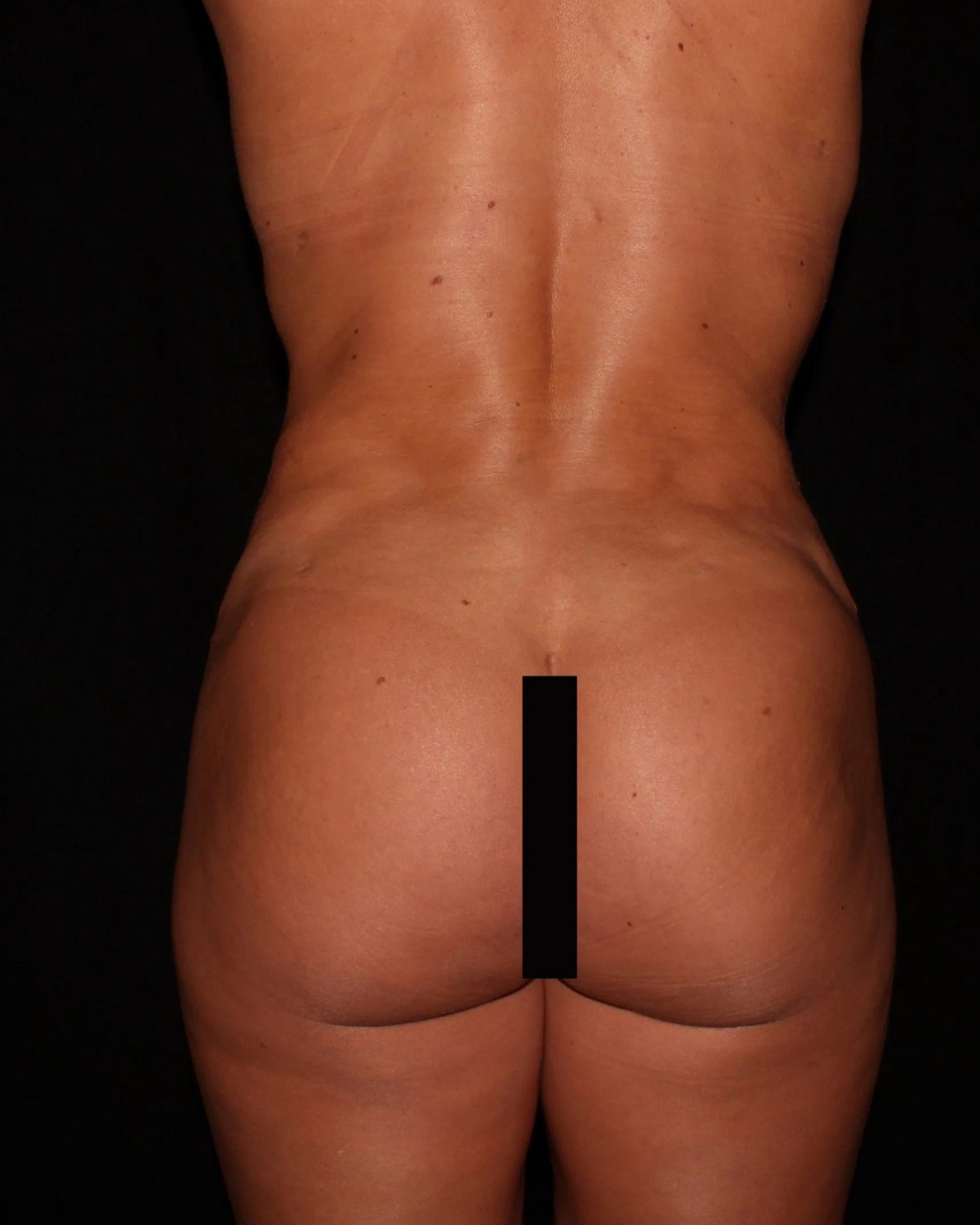 Implant Exchange Complete (Silicone Implants) — Back view, after