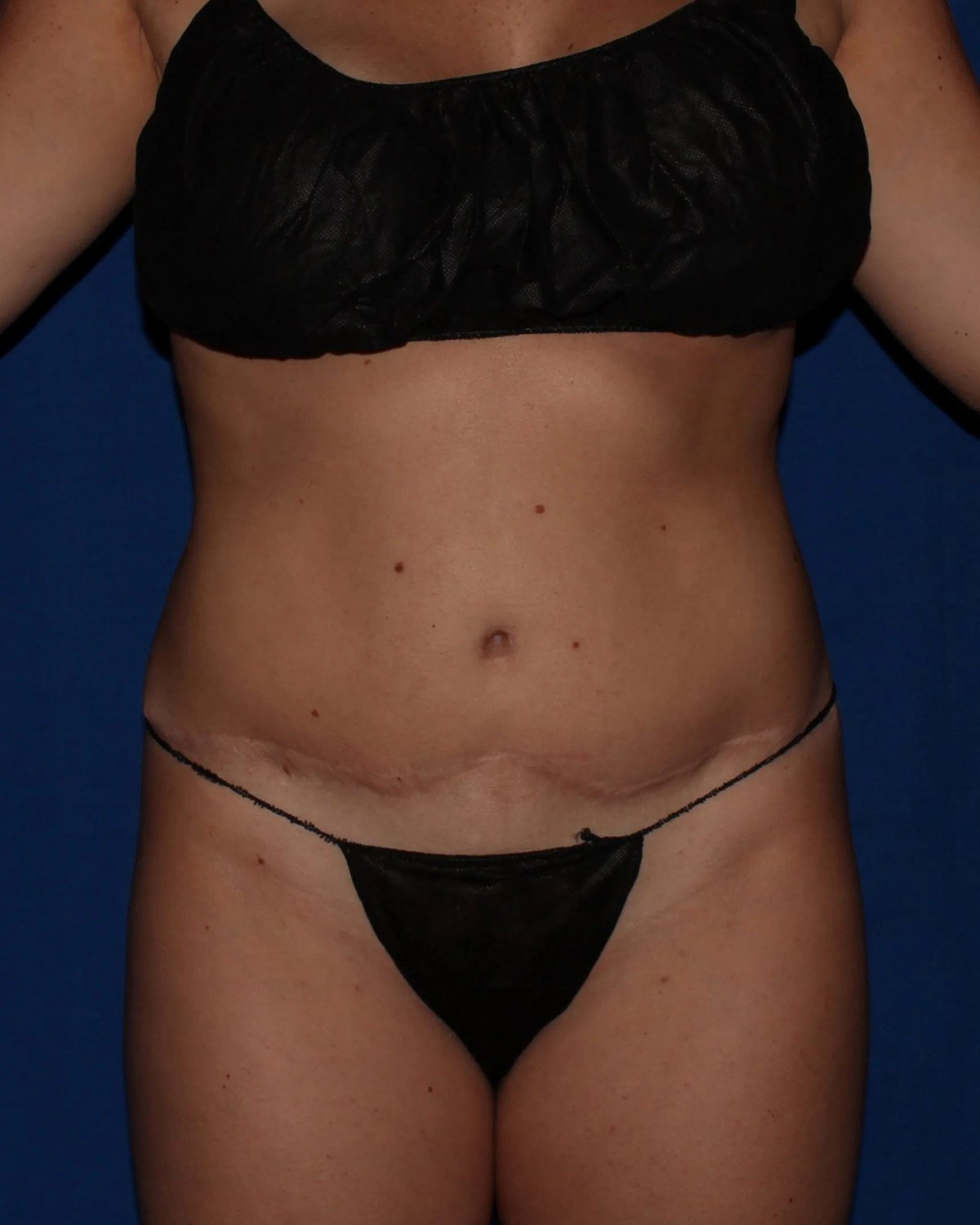 Before Implant Exchange Complete (Silicone Implants)