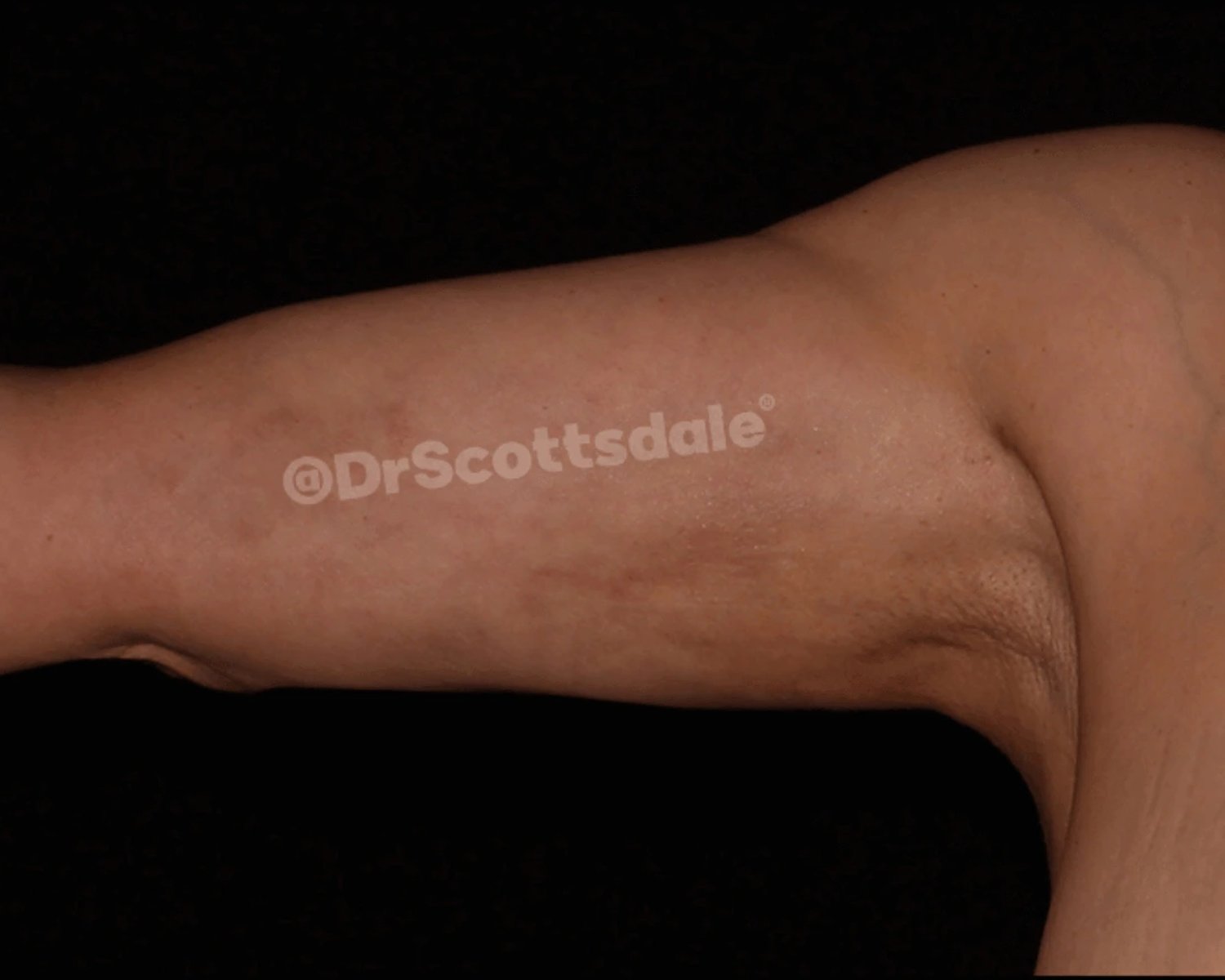 Arm Lift after