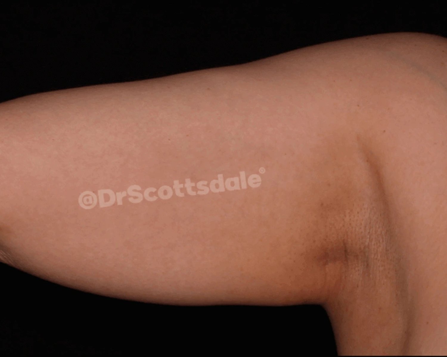 Arm Lift before