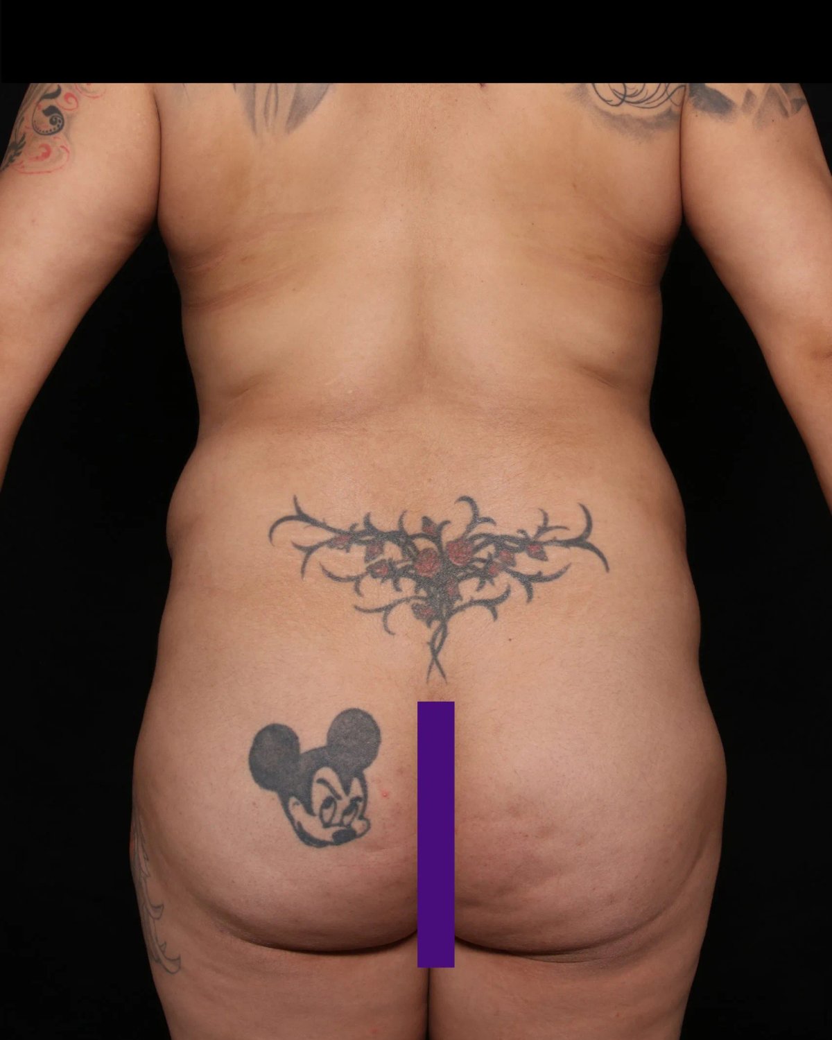 Front Liposuction (5L) (Same As Lipo360) — Back view, before