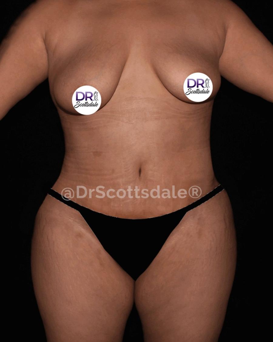 After Tummy Tuck