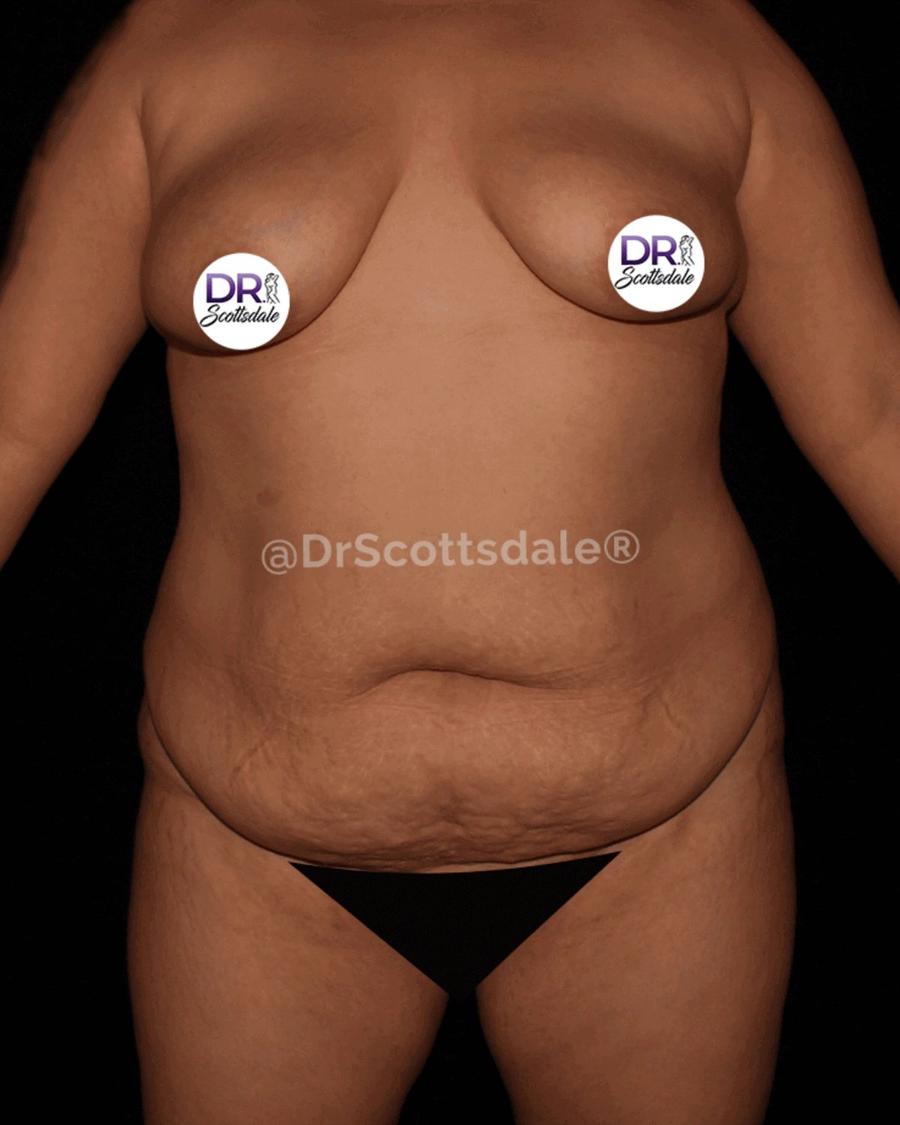 Before Tummy Tuck