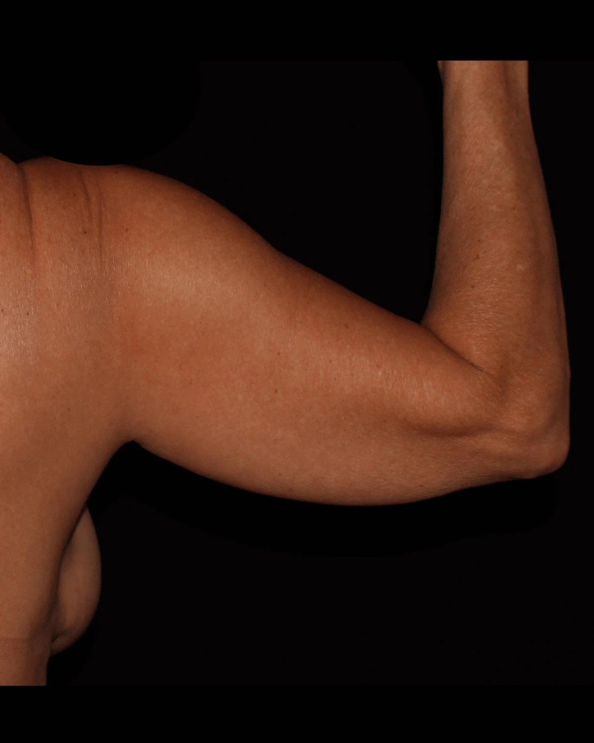 Arm Lift before