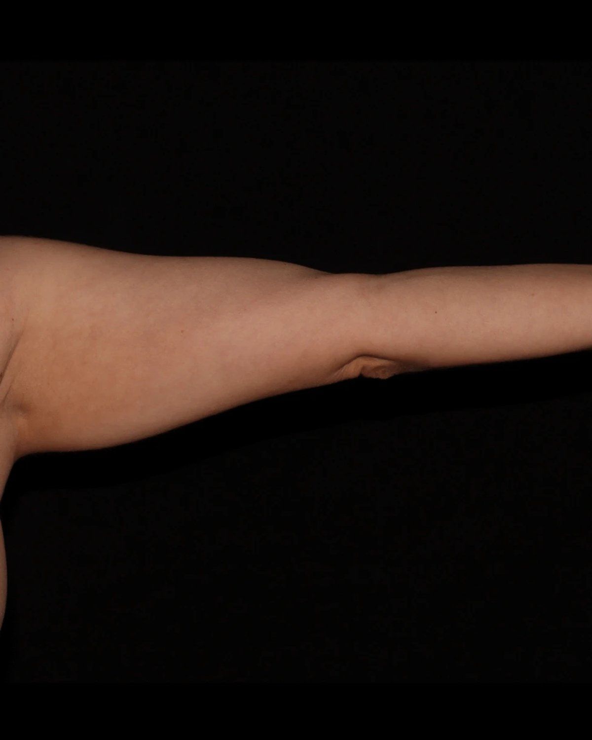 Arm Lift before