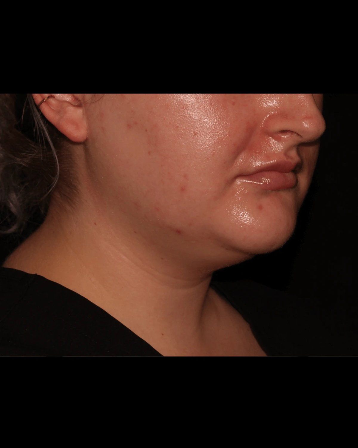 Buccal Fat Pad Removal before