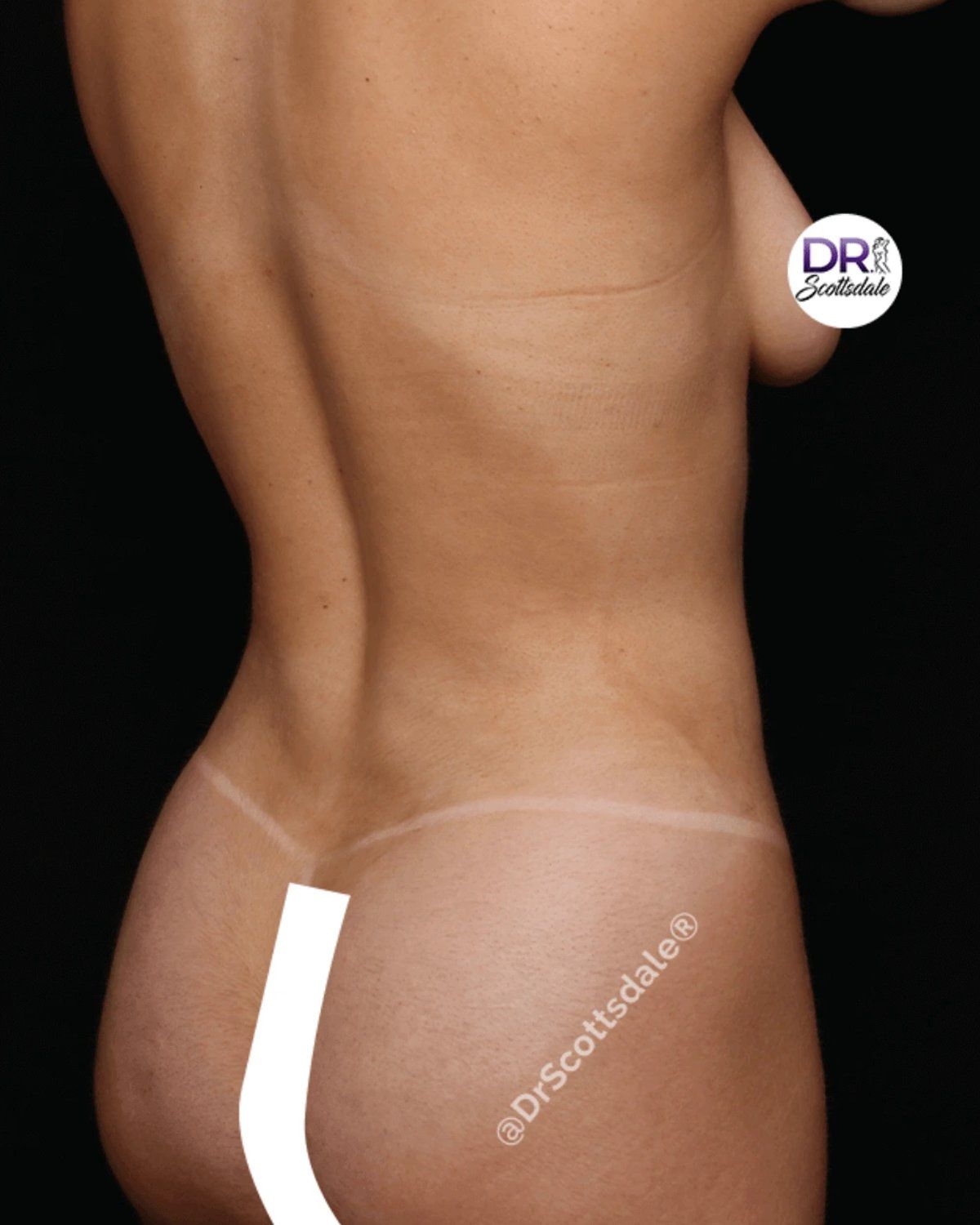 Vaser Lipo 360 (5L Max), Right Profile view, after