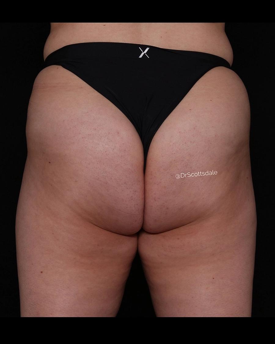After Lipedema