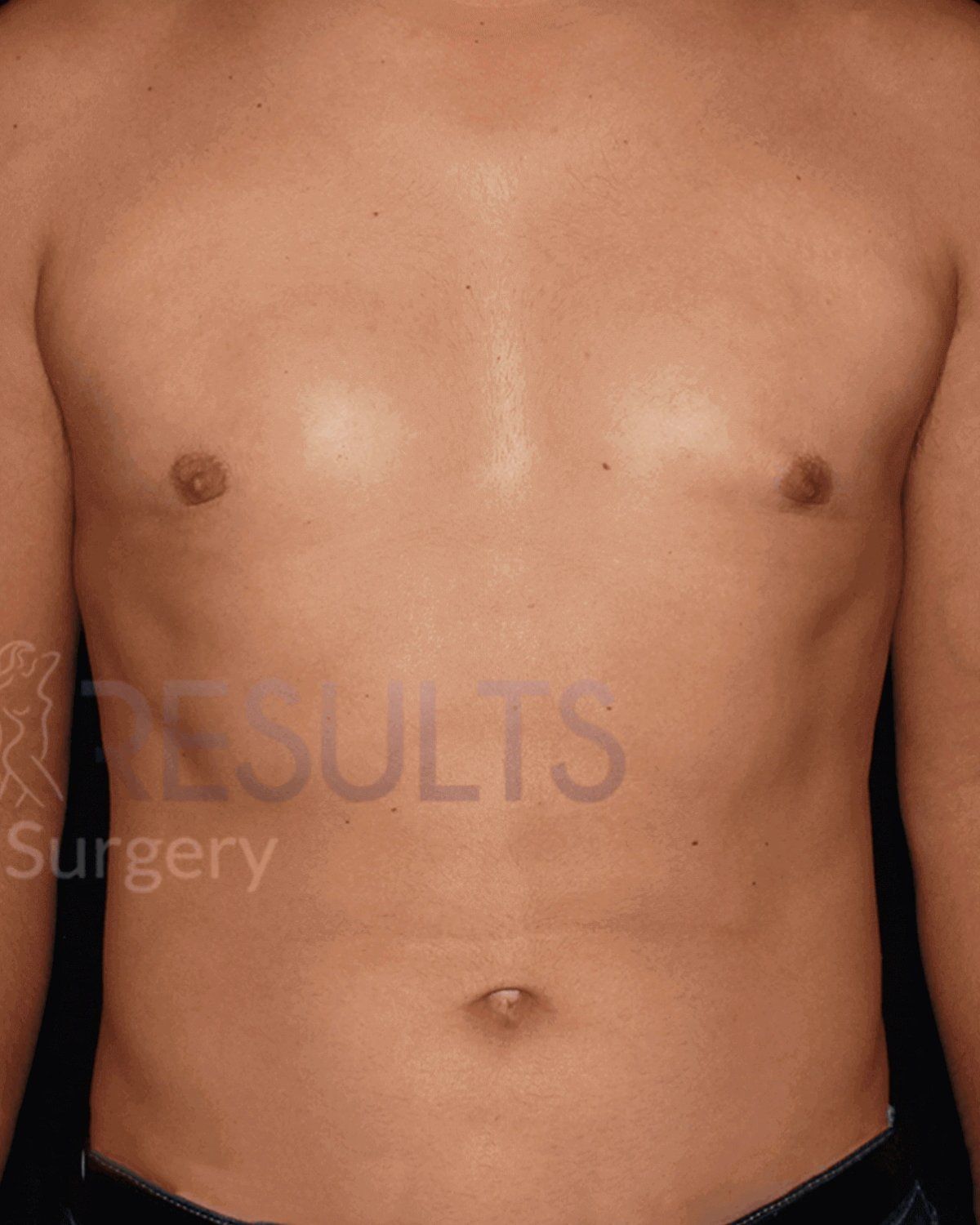 One-Stitch Gynecomastia after