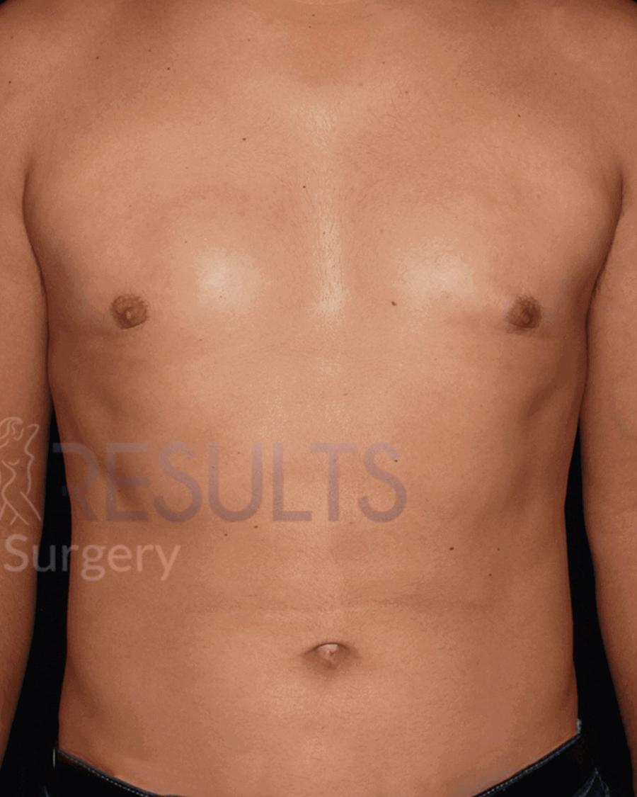 After One-Stitch Gynecomastia