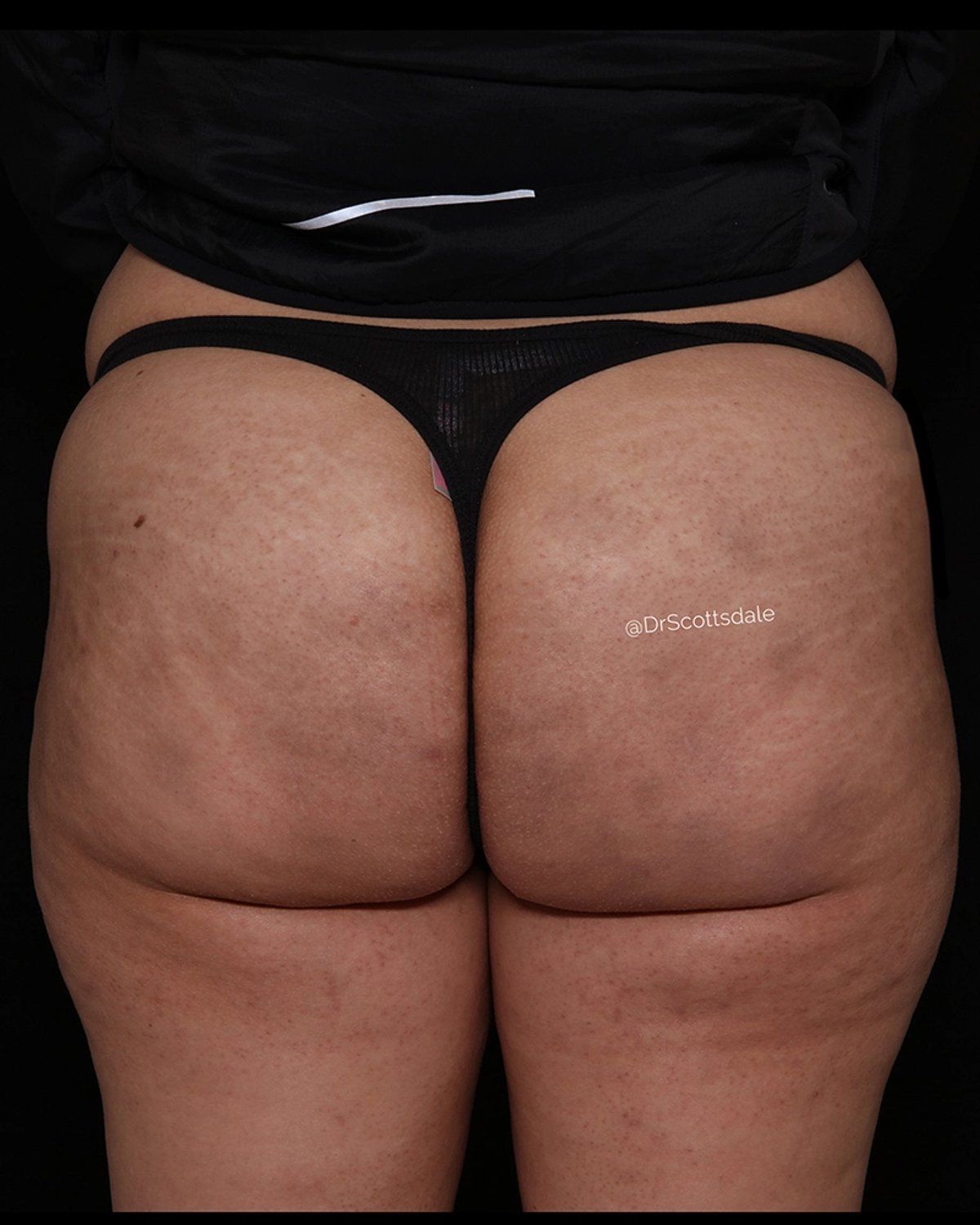 Lipedema after