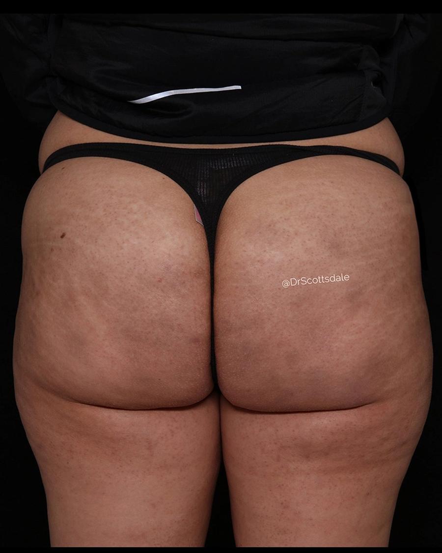 After Lipedema