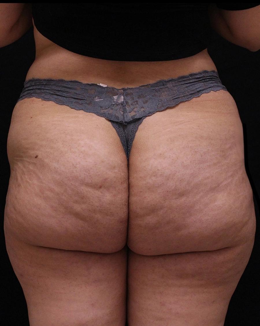 Before Lipedema