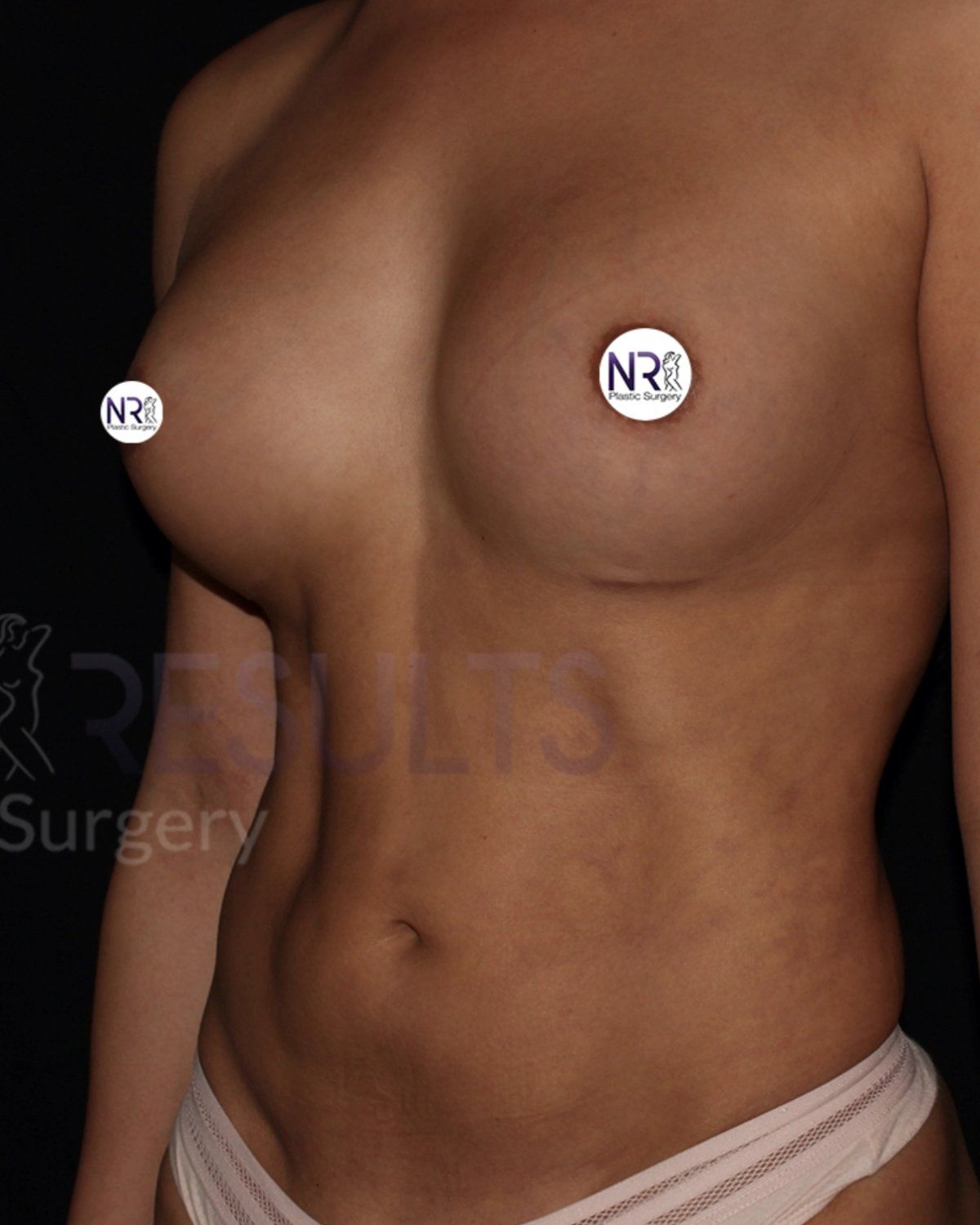 Vaser Lipo 360 (5L Max) after