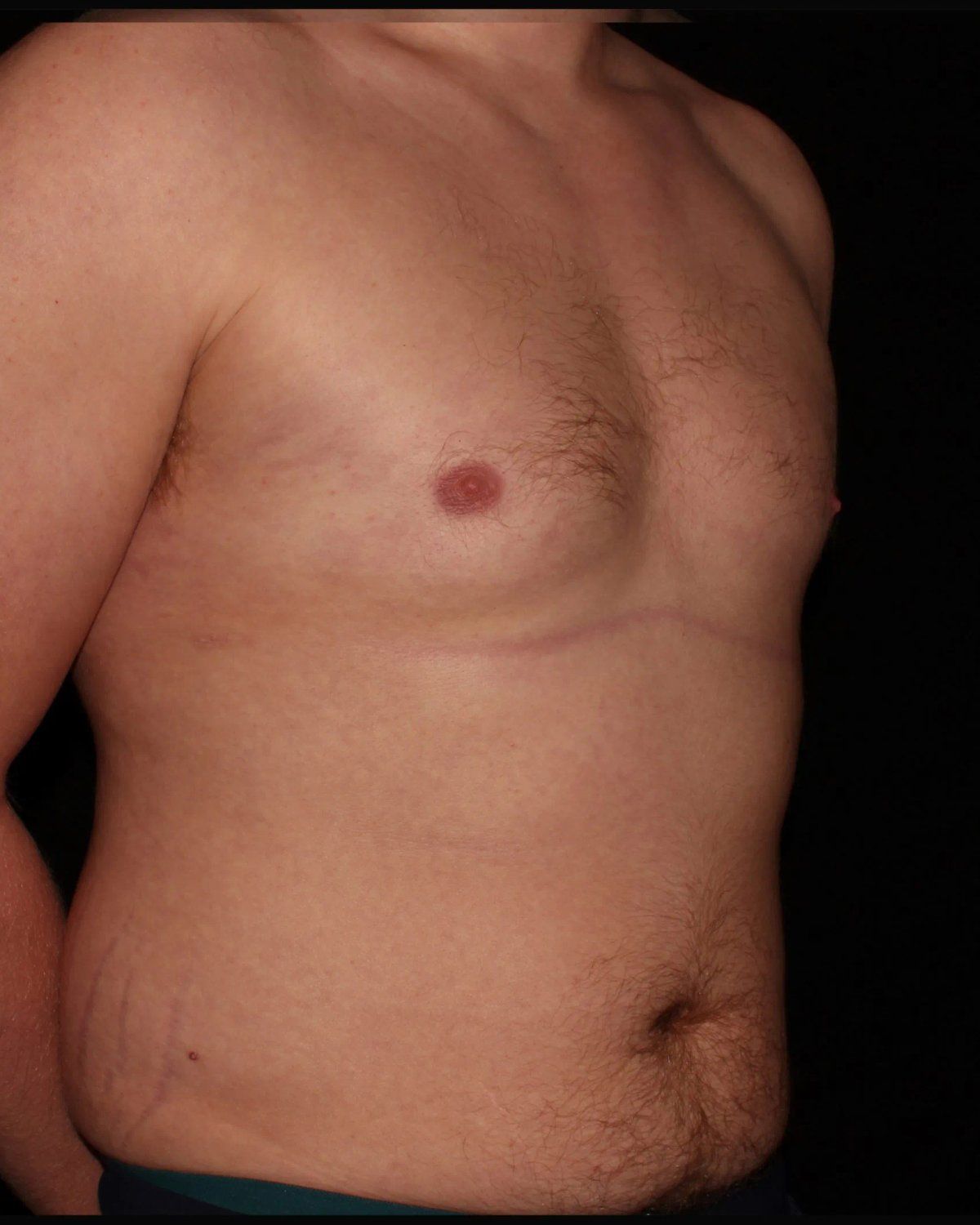 One-Stitch Gynecomastia after