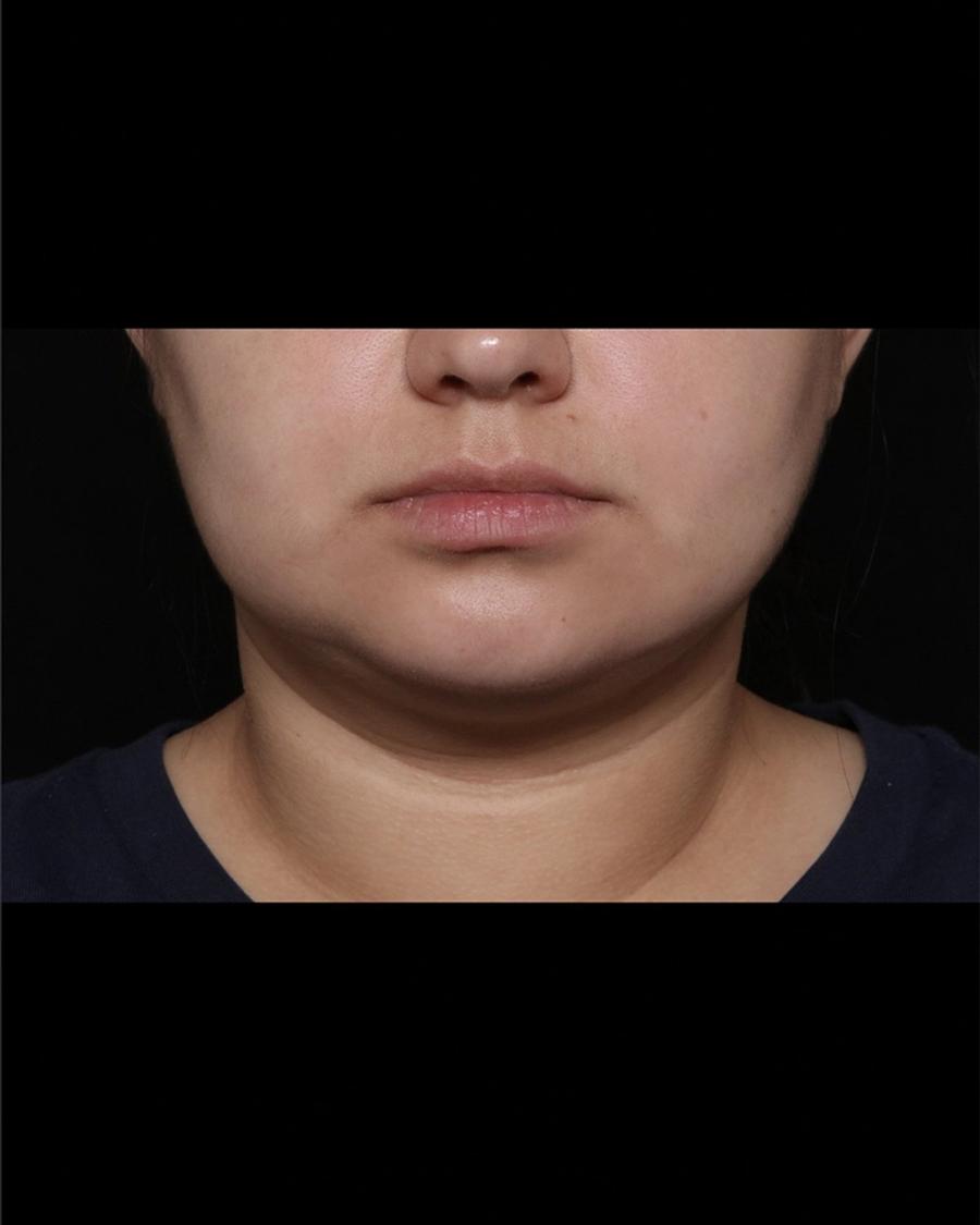 After Buccal Fat Pad Removal