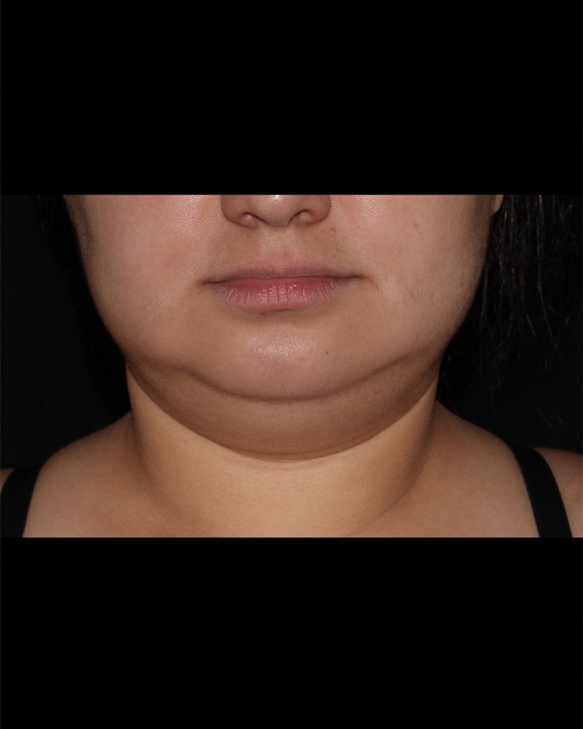 Buccal Fat Pad Removal before