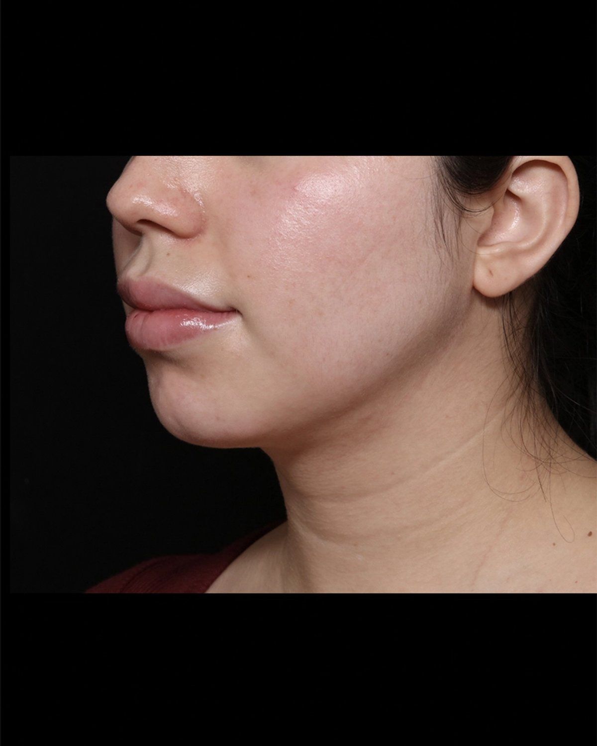 Buccal Fat Pad Removal after