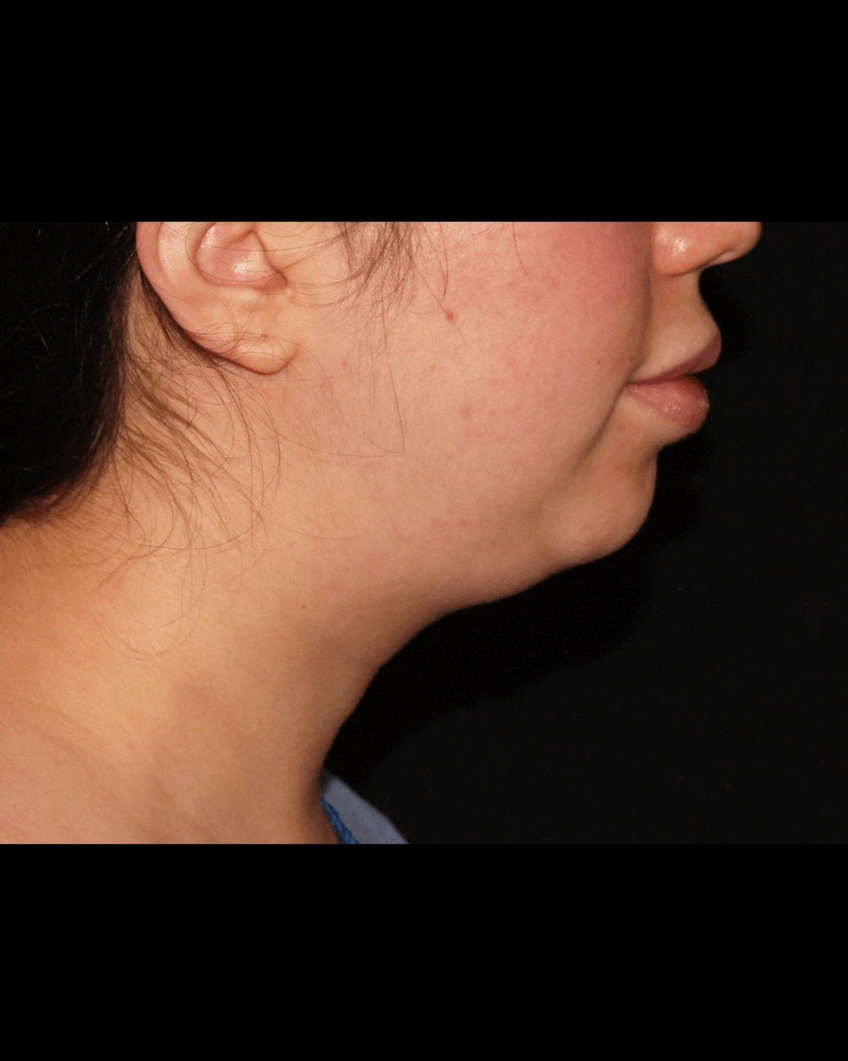 Buccal Fat Pad Removal — Oblique Right view, before