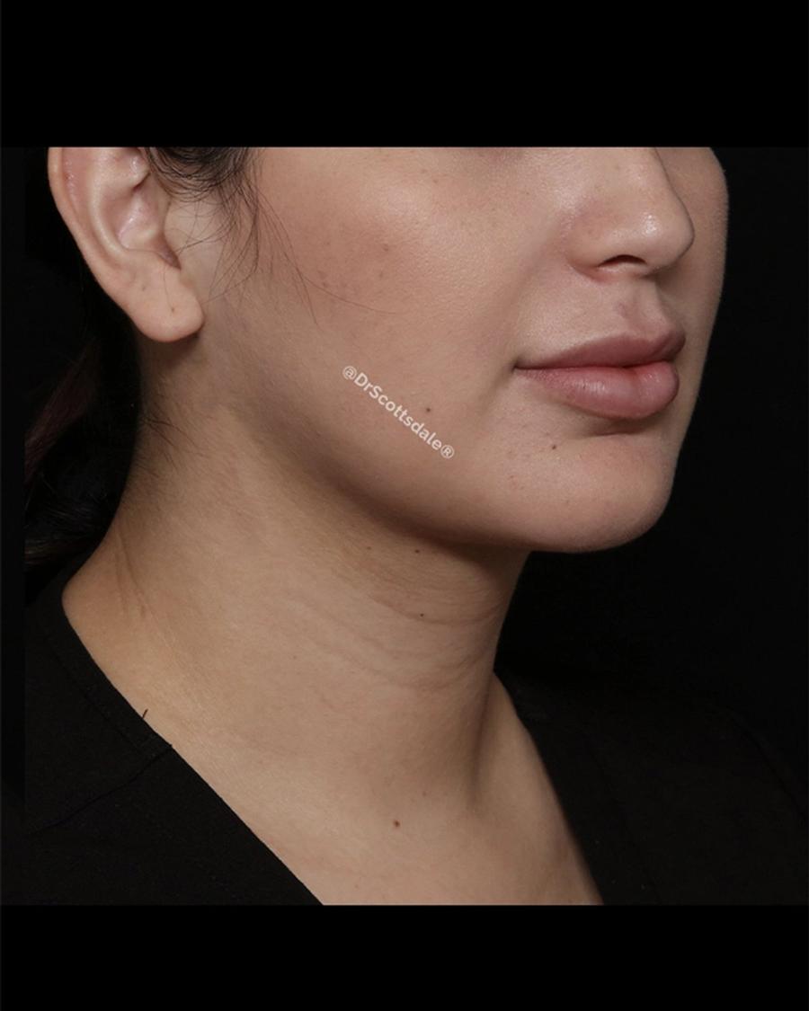 After Neck Liposuction w/ Magic Tight