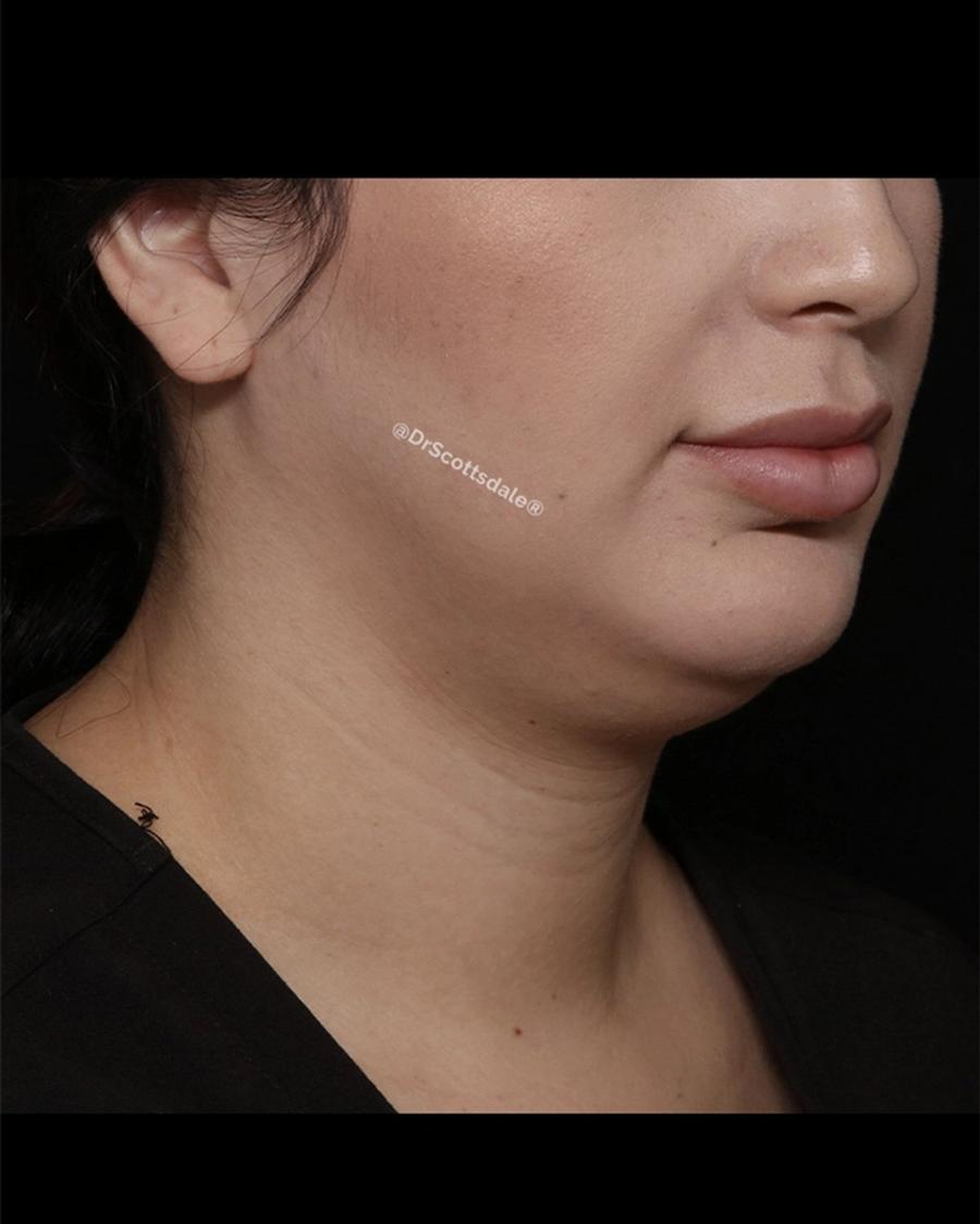 Before Neck Liposuction w/ Magic Tight