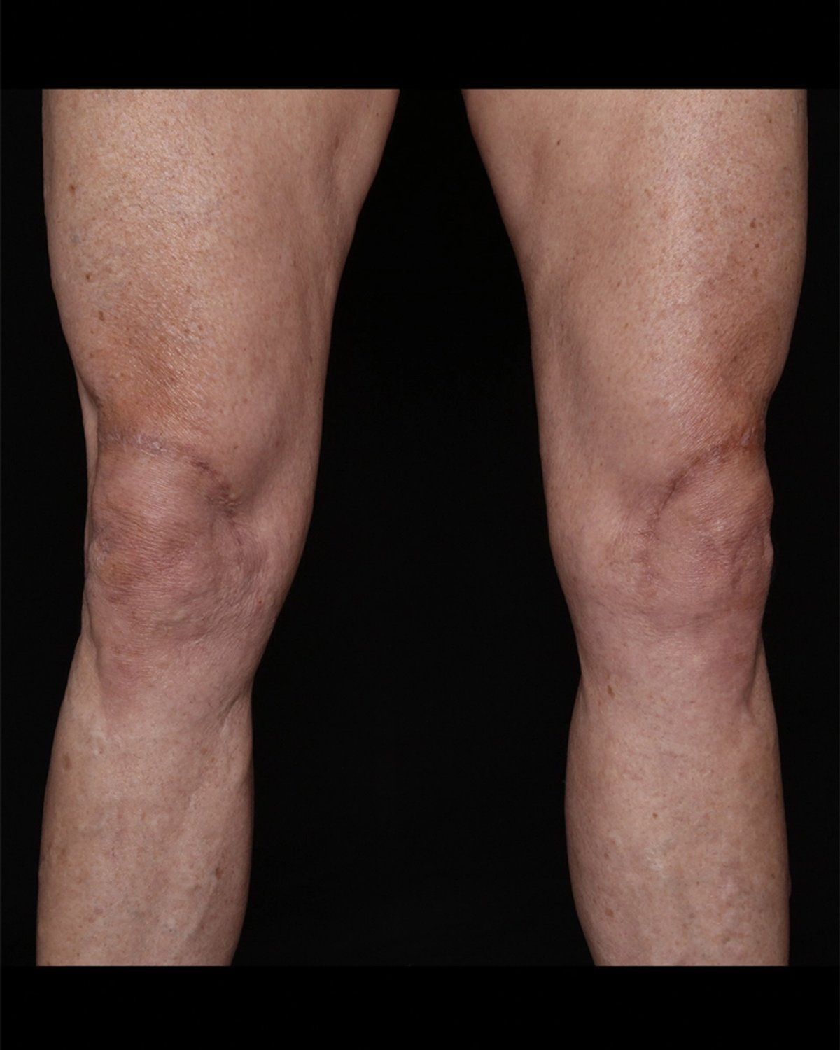 Thigh Lift (Medial) after