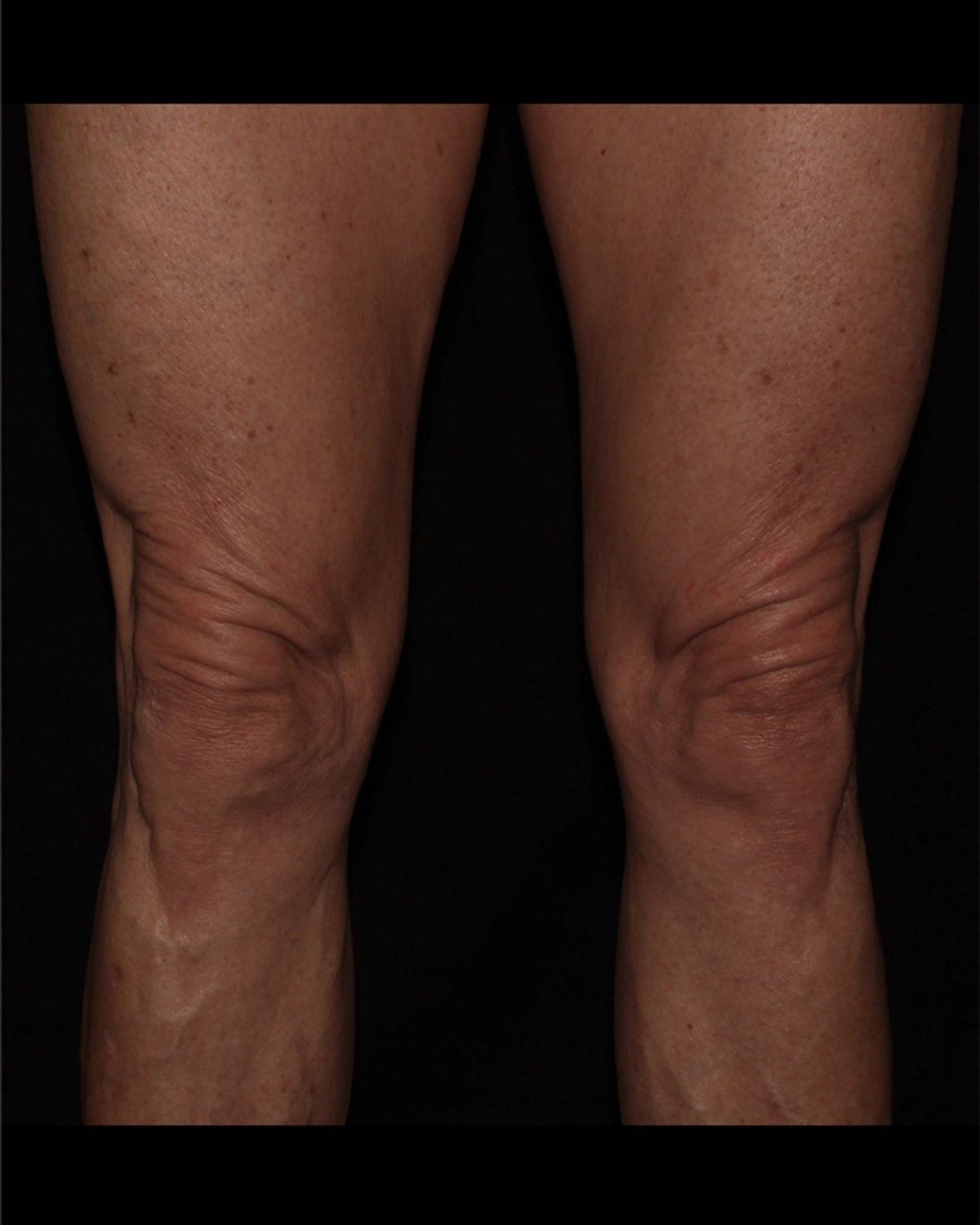 Thigh Lift (Medial) before
