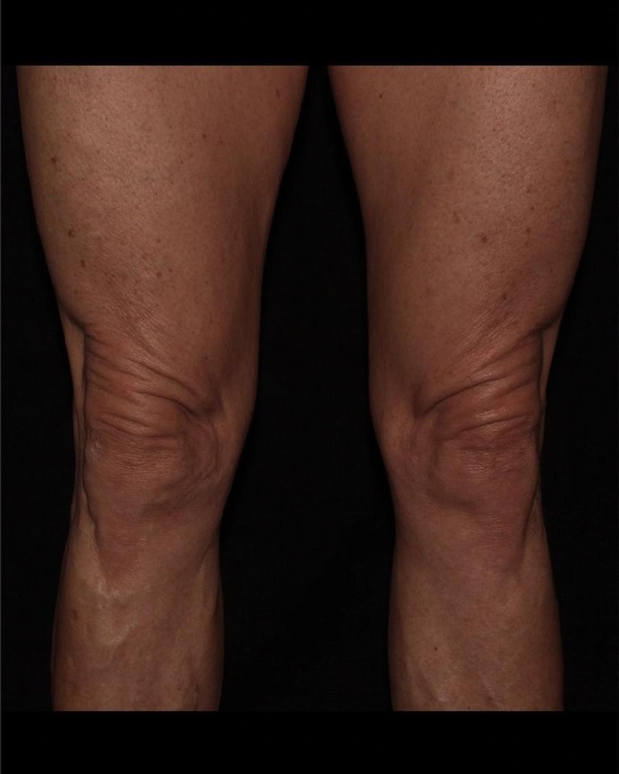 Before Thigh Lift (Medial)