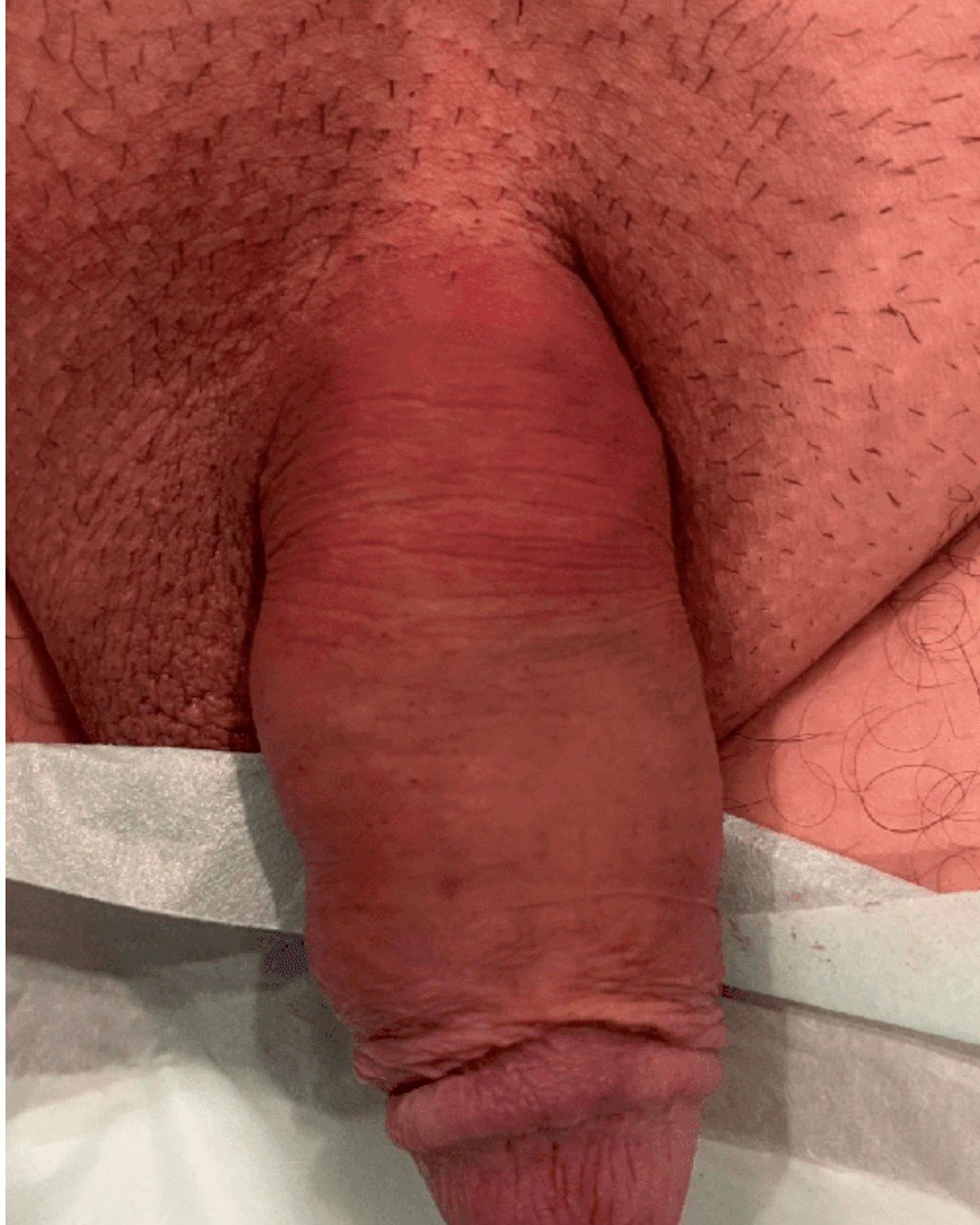 Penis Filler after