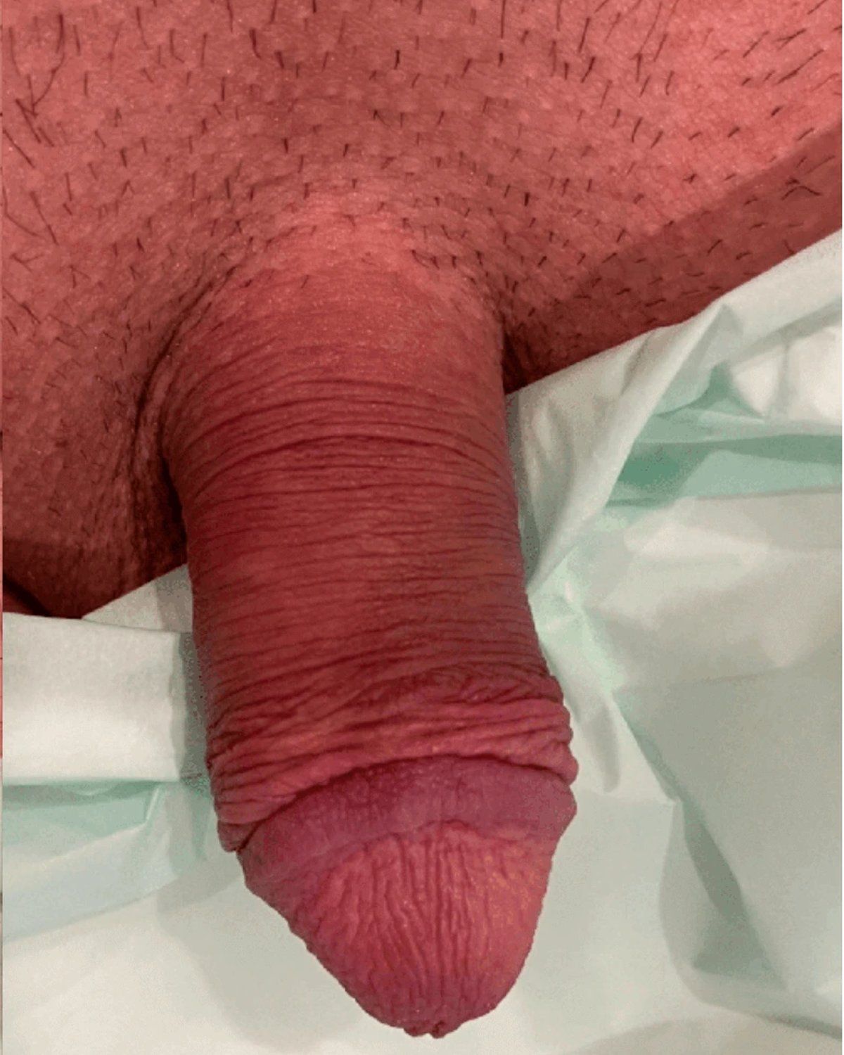 Penis Filler before