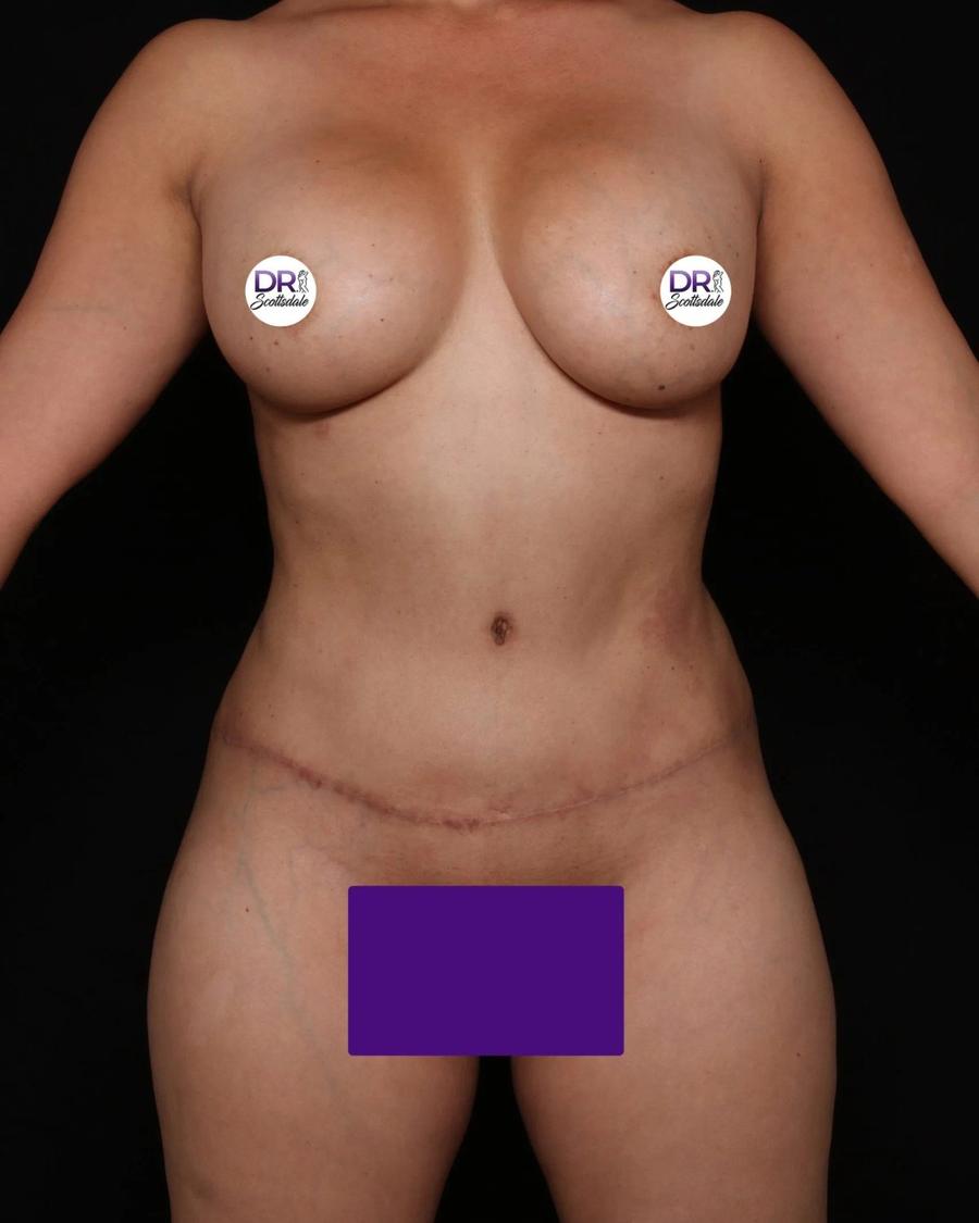 After Front Liposuction (5L) (Same As Lipo360)