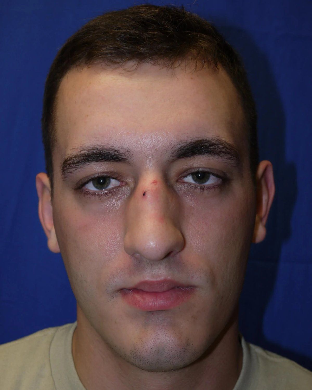 Rhinoplasty before