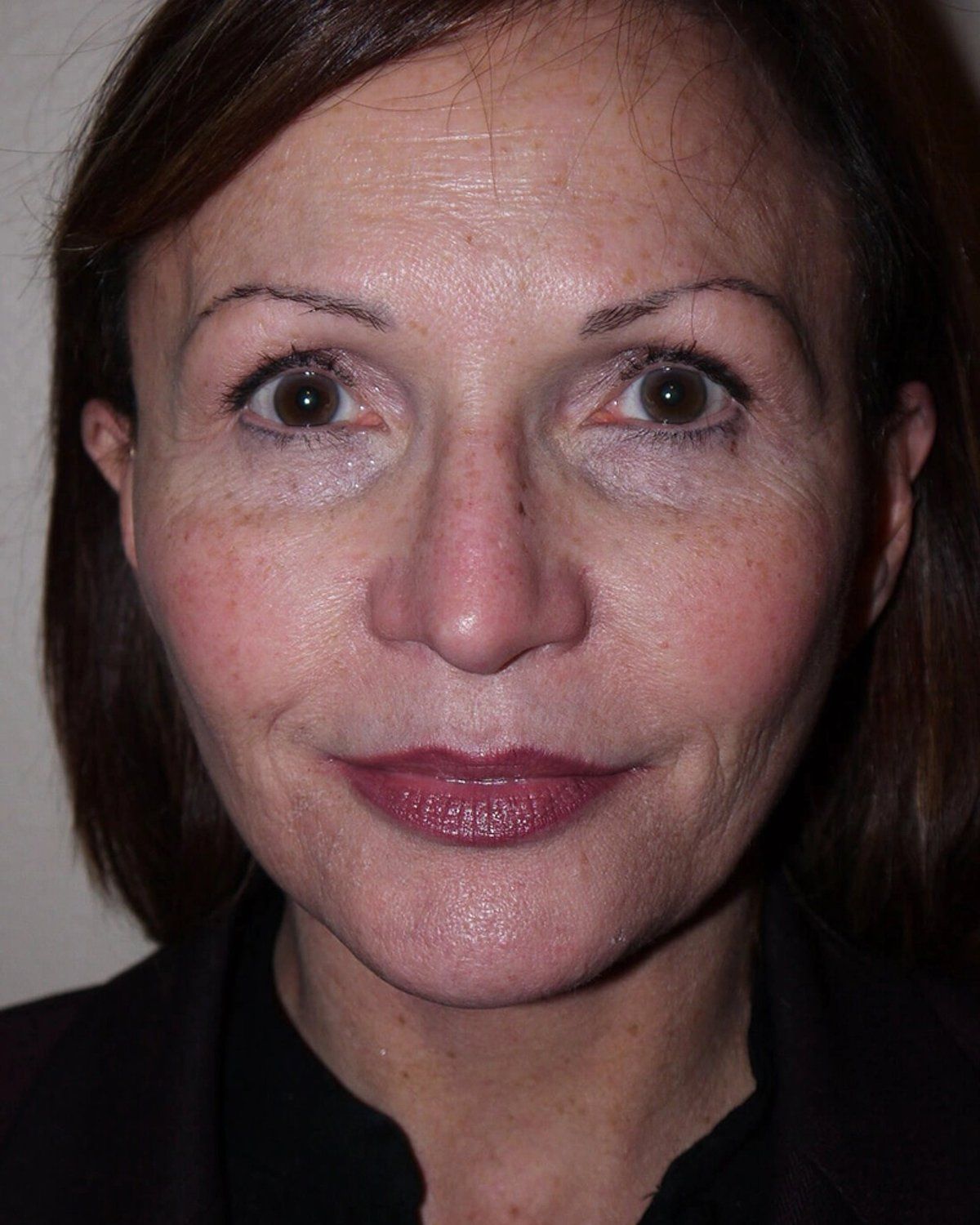 Facelift (neck lift included) after