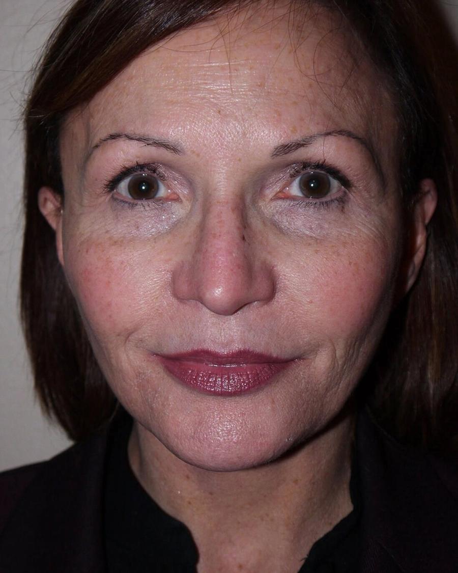 After Facelift (neck lift included)
