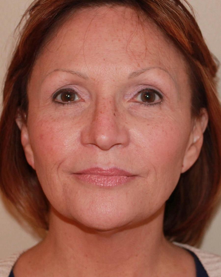 Before Facelift (neck lift included)