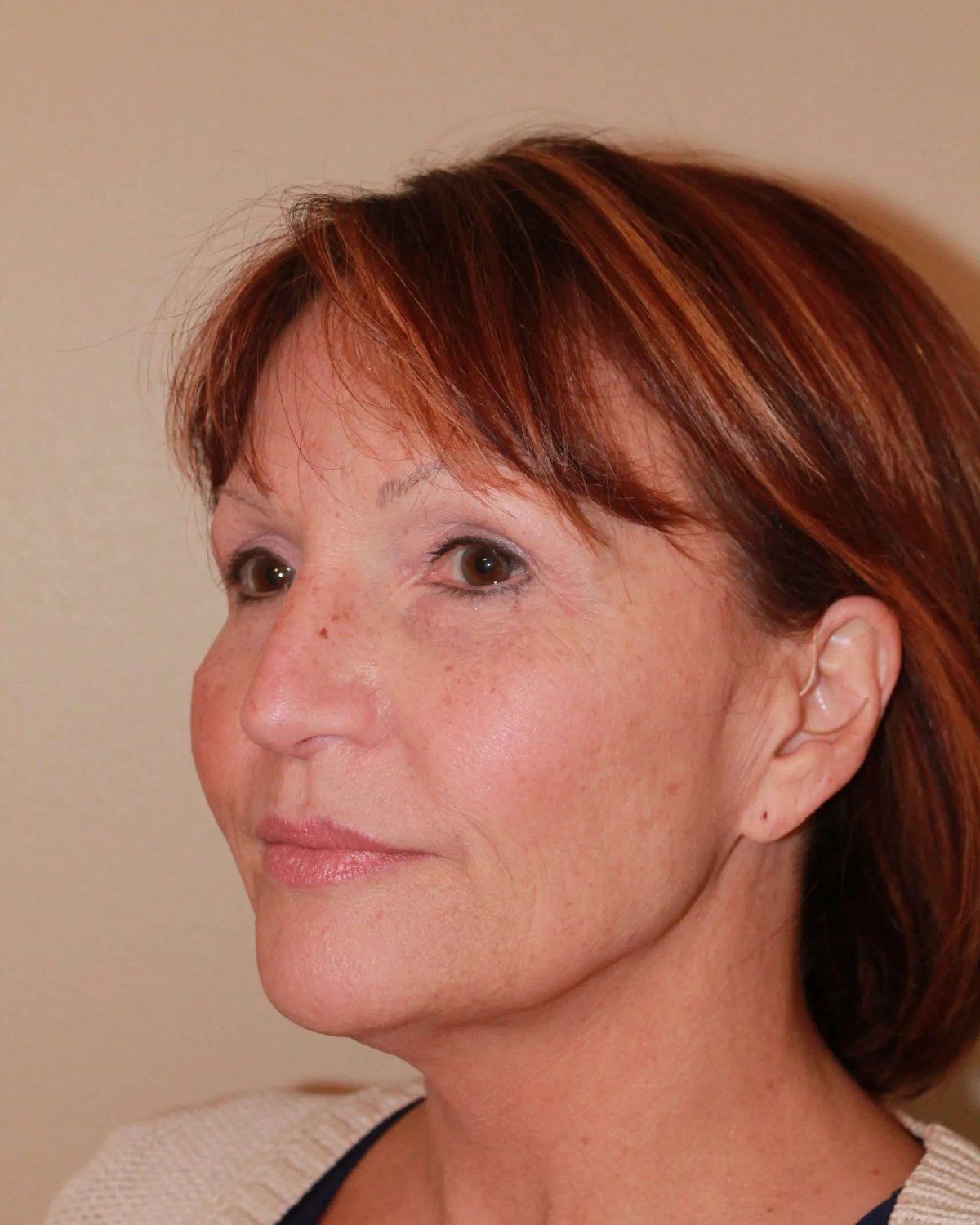 Facelift (neck lift included) — Oblique Left view, before