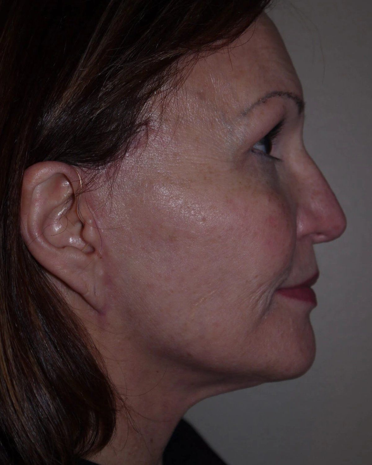 Facelift (neck lift included) — Oblique Right view, after