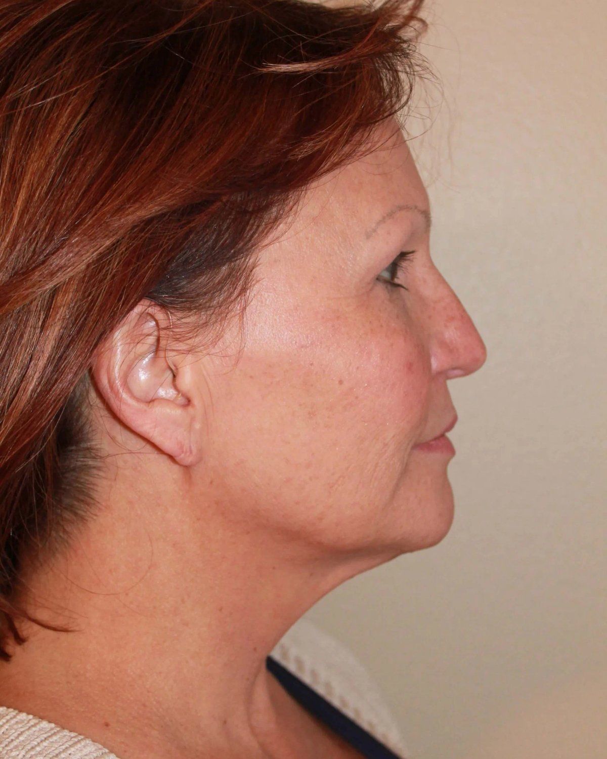 Facelift (neck lift included) — Oblique Right view, before