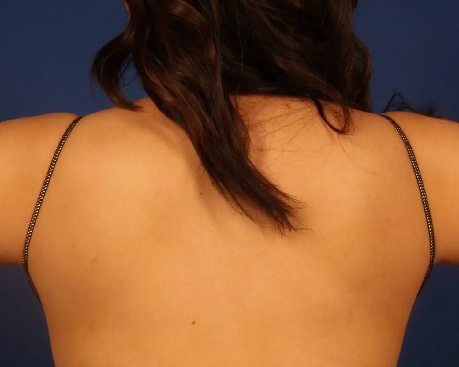 Arm Lift — Back view, before