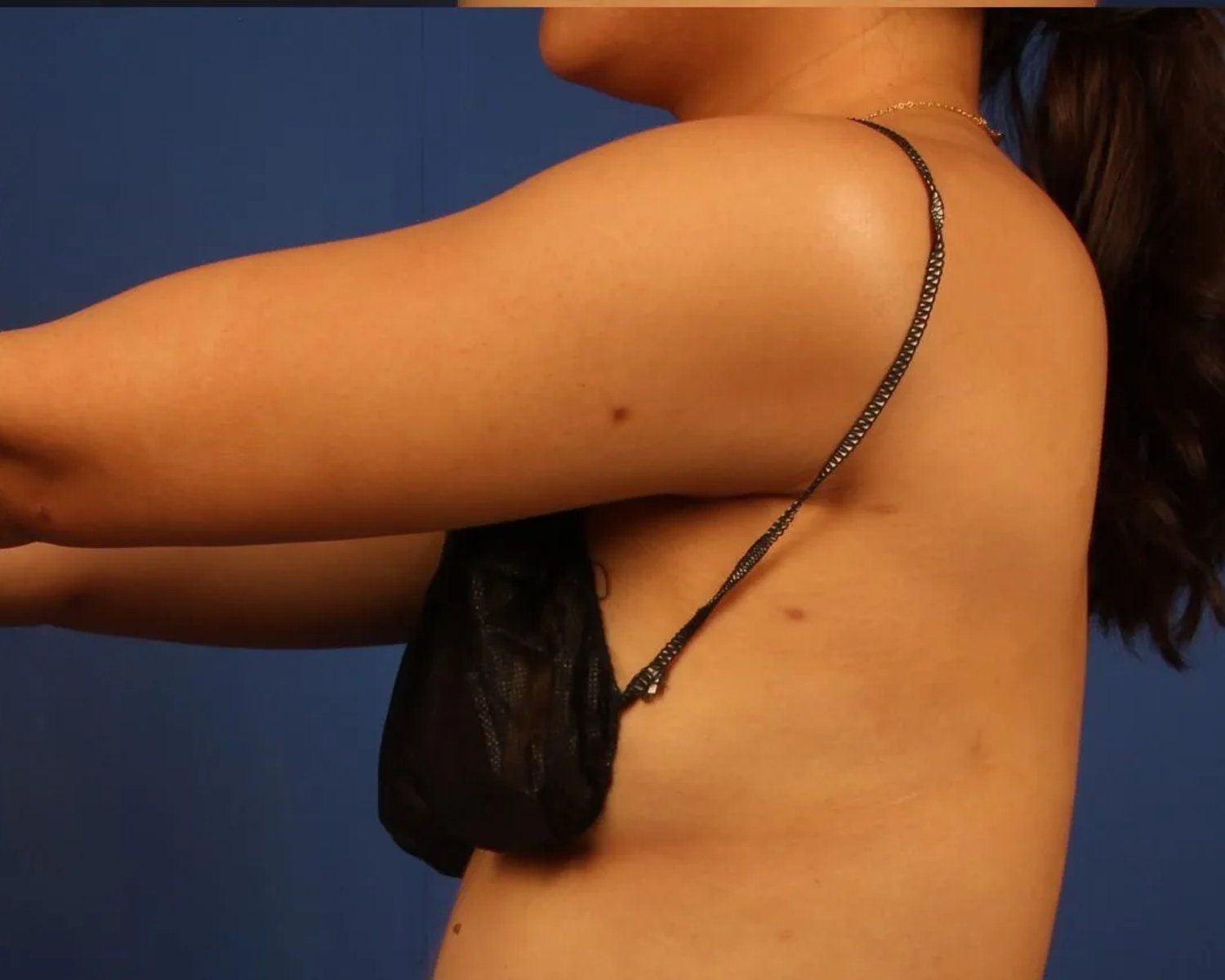 Arm Lift after