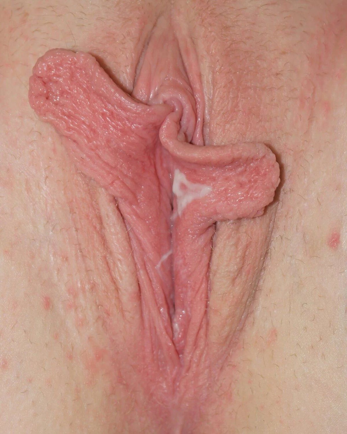 Labiaplasty before