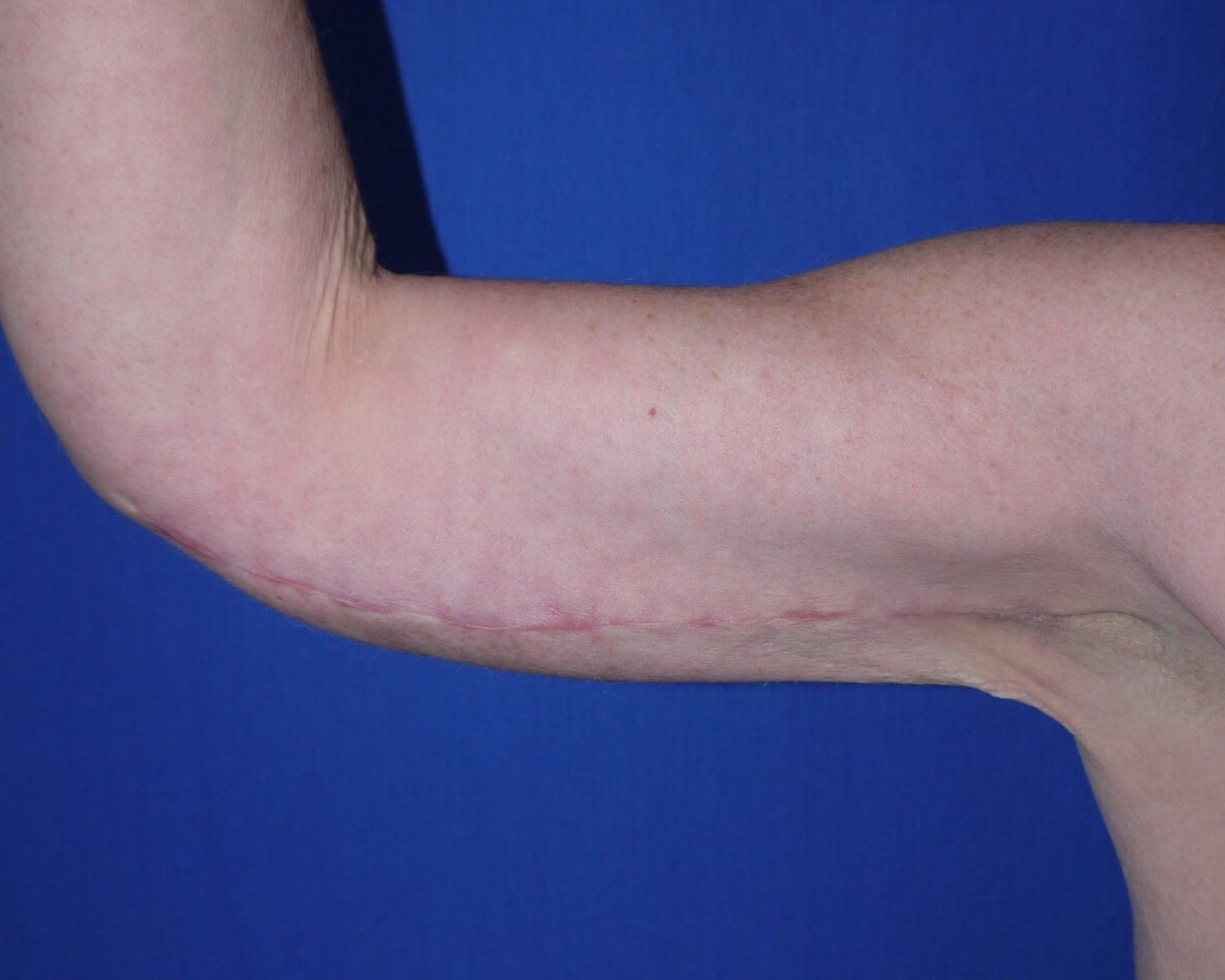 Arm Lift — Oblique Right view, after