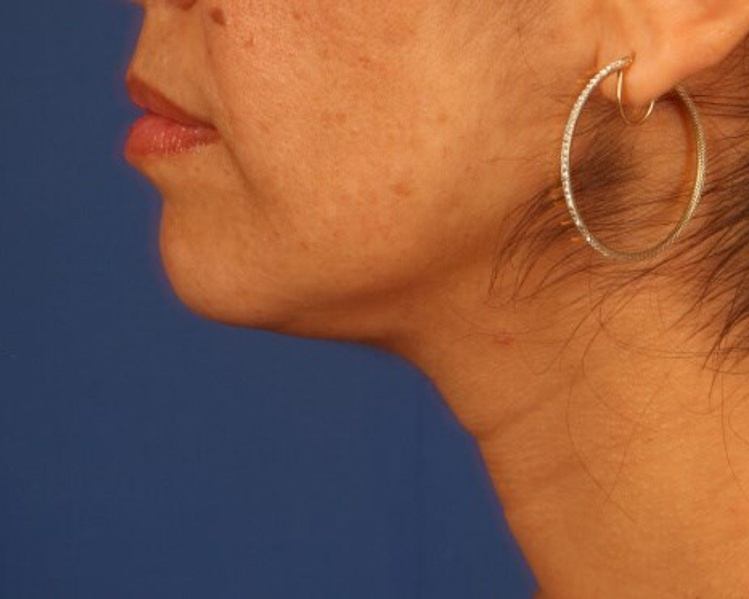 Neck Liposuction w/ Magic Tight after