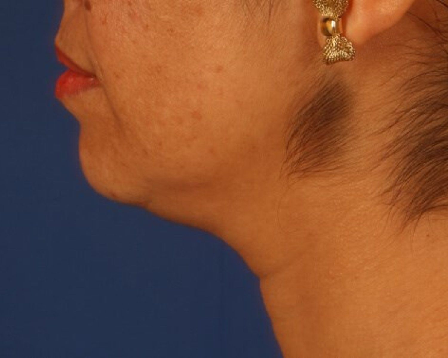 Neck Liposuction w/ Magic Tight before