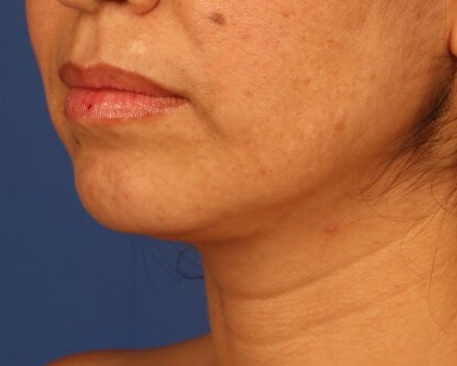Neck Liposuction w/ Magic Tight — Oblique Right view, after