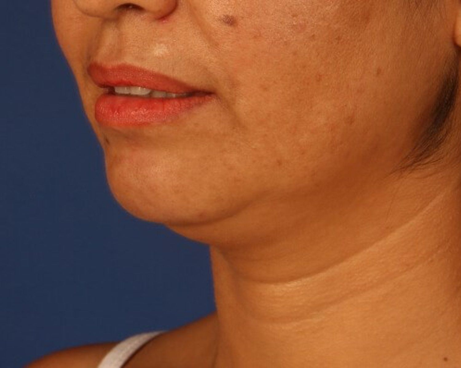 Neck Liposuction w/ Magic Tight — Oblique Right view, before