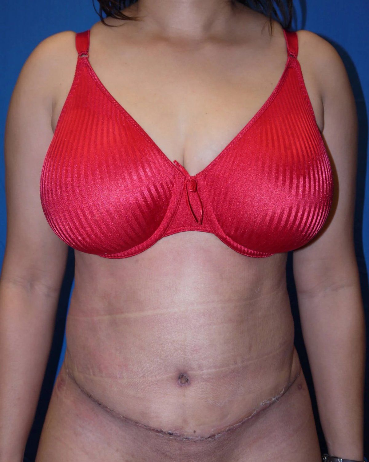 Tummy Tuck after